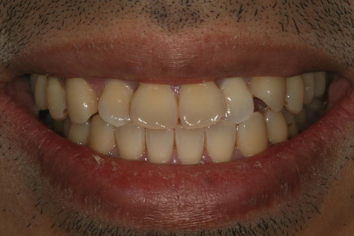 Professional teeth whitening before - dental cosmetics