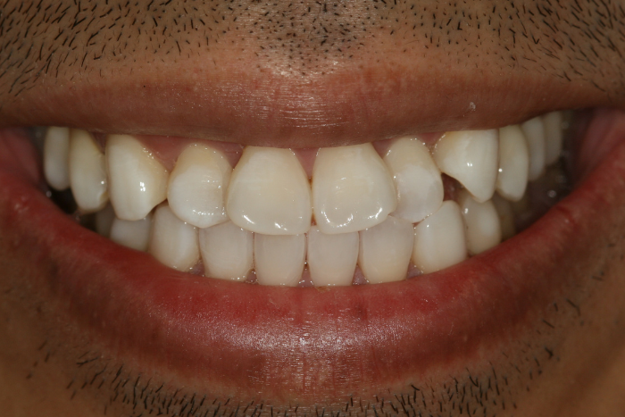 Cosmetic dentistry, professional teeth whitening smile makeover