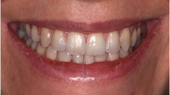 Invisalign teeth straightening transformation after