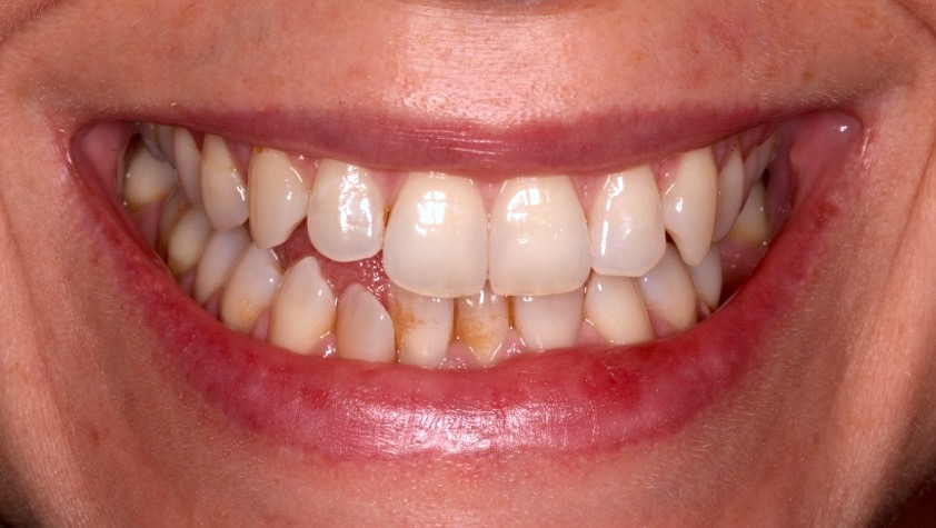 Invisalign teeth straightening transformation before