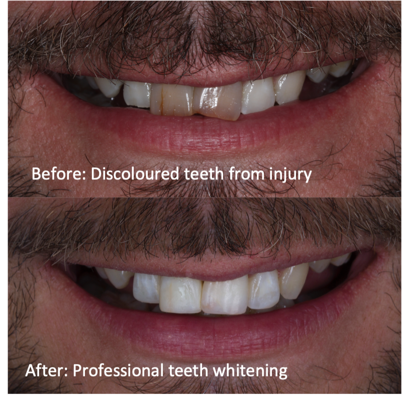 Advanced professional teeth whitening transformation on discoloured, necrotic teeth Montagu Dental.png