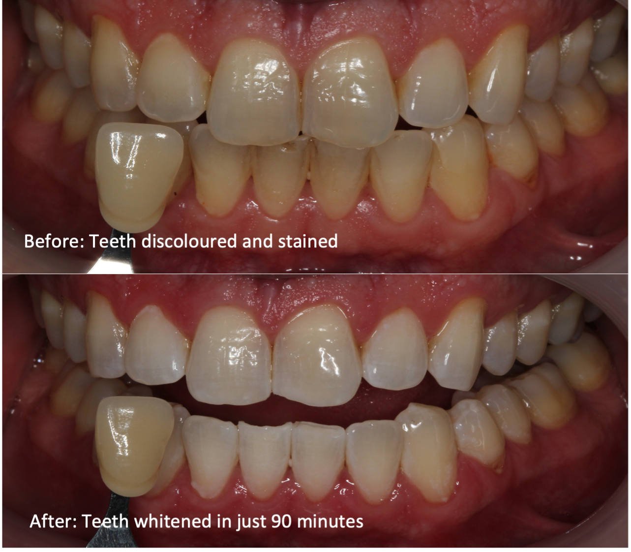Professional teeth whitening, in-surgery result at Montagu Dental