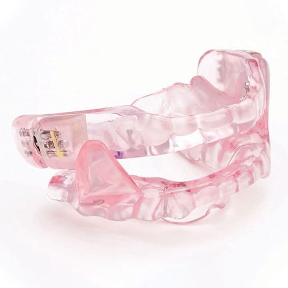 custom made mandibular advancement device for sleep apnoea, pink